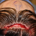 scalp access for skull bump reduction dr barry eppley indianapolis