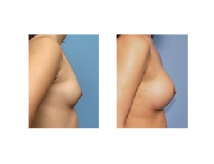 Asian Female Breast Augmentation result side view Dr Barry Eppley Indianapolis