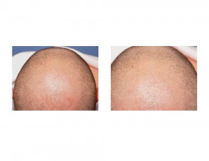 CO Skull Reduction scalp scar result