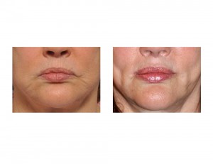 Corner of Mouth Lift with Perioral Mound Liposuction Dr Barry Eppley Indianapolis