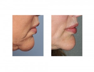 Corner of Mouth Lift with Perioral Mound Liposuction fersult side view Dr Barry Eppley Indianapolis