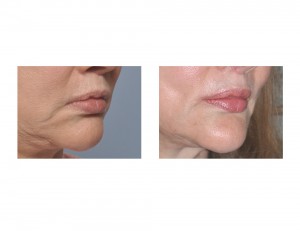 Corner of Mouth Lift with Perioral Mound Liposuction result oblique view Dr Barry Eppley Indianapolis