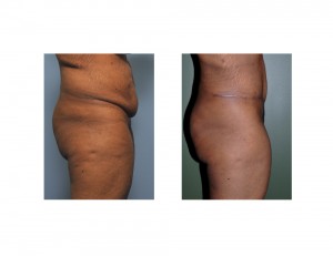 Extended Tummy Tuck results side view Dr Barry Eppley Indianapolis
