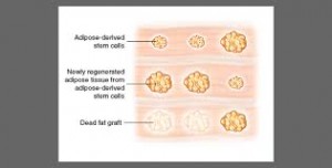 Fat Graft Survival Theory Dr Barry Eppley Indianapolis