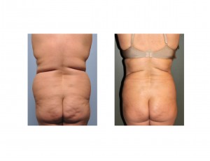 Muffin Top Liposuction Dr Barry Eppley Indianapolis