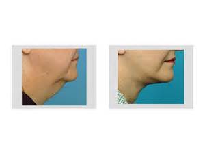Neck Fat Removal Dr Barry Eppley Indianapolis