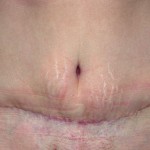 Umbilical Reconstruction in Tummy Tuck Dr Barry Eppley Indianapolis