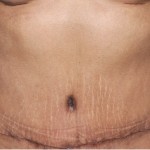 Umbilical Translocation in Tummy Tuck Indianapolis Dr Barry Eppley