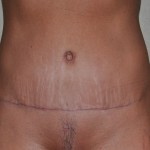 Umbilical Translocation in Tummy Tuck result Dr Barry Eppley Indianapolis