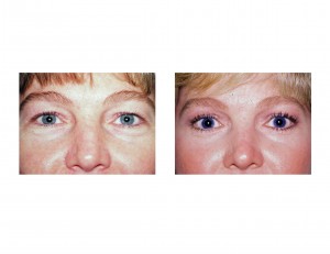 Blepharoplasty (Eyelid Tuck) Dr Barry Eppley Indianapolis