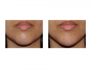 Injectable Chin Augmentation (Voluma) result front view Dr Barry Eppley Indianapolis