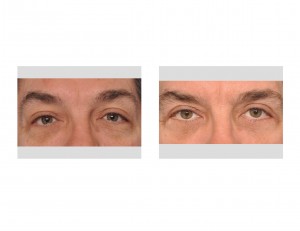 Male Blepharoplasty result front view Dr Barry Eppley Indianapolis