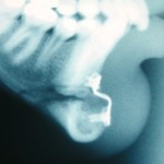 Sliding Genioplasty X-ray Dr Barry Eppley Indianapolis