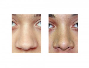 Teenage Rhinoplasty result front view Dr Barry Eppley Indianapolis