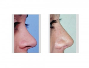 Teenage Rhinoplasty result side view Dr Barry Eppley Indianapolis