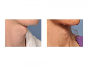 Transgender Tracheal Shave result oblique view Dr Barry Eppley Indianapolis