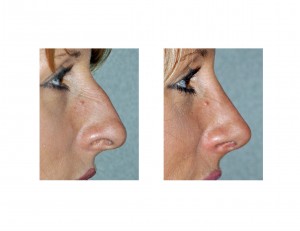 Rhinoplasty Tip Rotation and Projection in Rhinoplasty Dr Barry Eppley Indianapolis