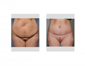 Belly Button Reshaping in Tummy Tuck Dr Barry Eppley Indianapolisjpg