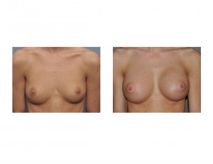 Breast Augmentation results front view Dr Barry Eppley Indianapolis