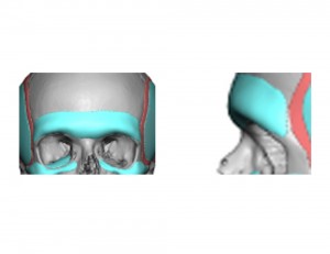 Custom Brow Bone Implant Design Dr Barry Eppley Indianapolis