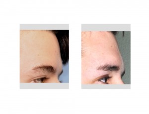 Endoscopic Brow Bone Implant result side view Dr Barry Eppley Indianapolis