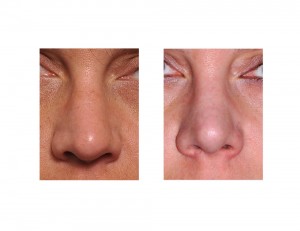 Long Nose Rhinoplasty result front view Dr Barry Eppley Indianapolis
