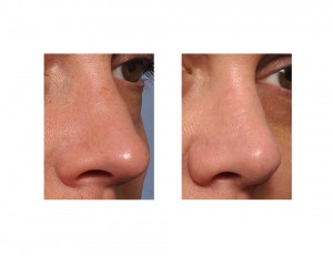 Long Nose Rhinoplasty result oblique view Dr Barry Eppley Indianapolis