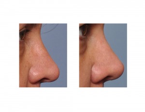 Long Nose Rhinoplasty result side view Dr Barry Eppley Indianapolis
