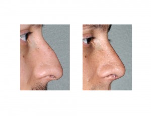Male Hump Reduction Rhinoplasty result side view Dr Barry Eppley Indianapolis