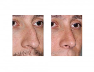 Male Hump Reduction Rhinoplasty results oblique view Dr Barry Eppley Indianapolis