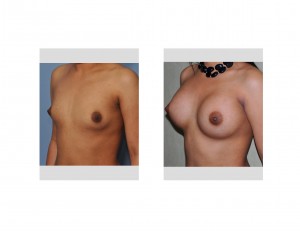 Breast Augmentation in Hispanic Women Dr Barry Eppley Indianapolis