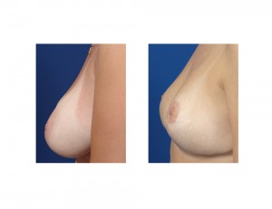 Breast Reduction early result side view Dr Barry Eppley Indianapolis