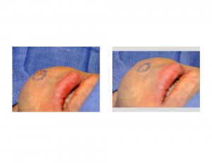 Chin Dimple Surgery Technique Dr Barry Eppley Indianapolis