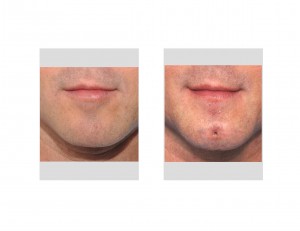 Chin Dimple Surgery result front view Dr Barry Eppley Indianapolis