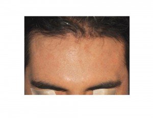 Forehead Widening Implant result Dr Barry Eppley Indianapolis