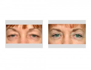 Upper and Lower Blepharoplasty result front view Dr Barry Eppley Indianapolis