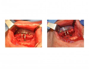 Chin Implant and Sliding Geniplasty in Large Chin Augmentations Dr Barry Eppley Indianapolis