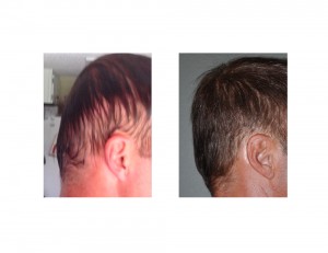 Custom Occipital Implabnt result with Hair Transplant Scars Dr Barry Eppley Indianapolis