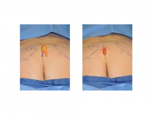 Dermal Fat Graft to Coccyx Indianapolis Dr Barry Eppley