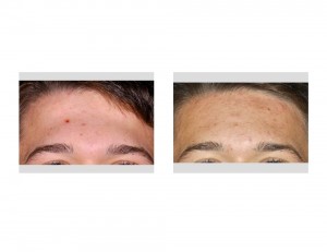 Forehead Recontouring result front view