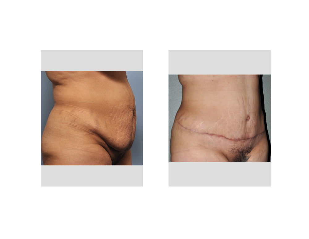 Case Study: Tummy Tuck for the Clefted Abdominal Pannus in a Hispanic  Female - Explore Plastic Surgery