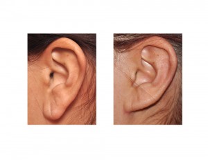 Otoplasty with Earlobe Reduction result left side