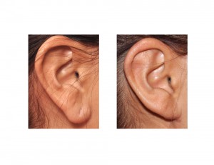 Otoplasty with Earlobe Reduction result right side Dr Barry Eppley Indianapolis
