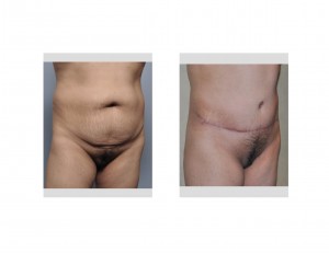 Pubic Lift in a Tummy Tuck oblique view Dr Barry Eppley Indianapolis