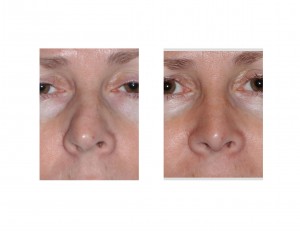 Airway Preserving Rhinoplasty Dr Barry Eppley Indianapolis front view