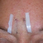 Glabellar Implants Dr Barry Eppley Indianapolis