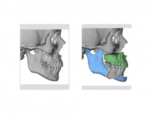 Orthognathic Surgery for Obstructive Sleep Apnea Computer Planning Dr Barry Eppley Indianapolis