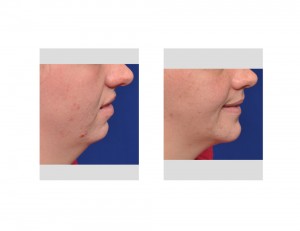 Orthognathic Surgery for Obstructive Sleep Apnea Dr Barry Eppley Indianapolis side view