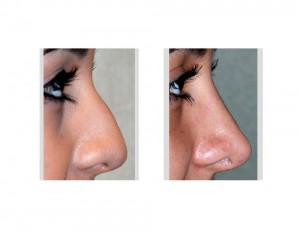Teen Rhinoplasty result Indianapolis Dr Barry Eppley