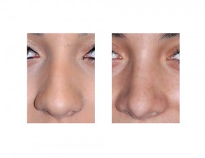 Teen Rhinoplasty result front view Indianapolis Dr Barry Eppley Indianapolis